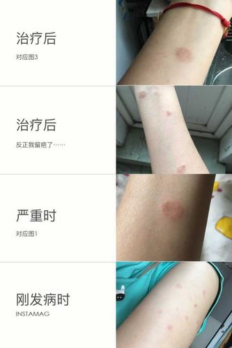 人如果得了猫癣怎么办?