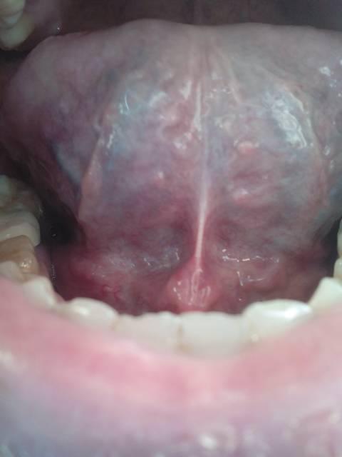 舌底有这样像小肉揪似的正常吗?