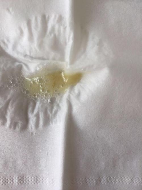 现在的痰是这样的,白了些,咳嗽也减轻了,咳出痰后,感觉肺部顺畅了很多