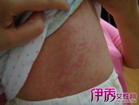 【图】小孩药物过敏症状图片怎么样 重要的是注意休息和多喝开水