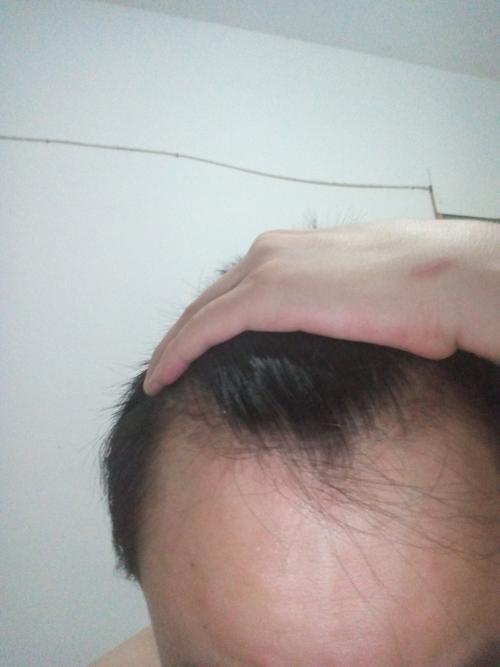 像我这样两边额头没头发,头发软,贴头皮,适合什么发型