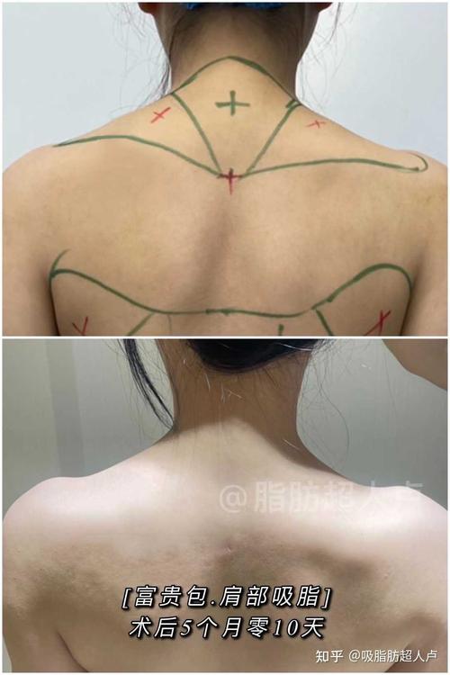 吸脂肪超人卢 的想法: 富贵包吸脂77肩部吸脂术后5个月零10天复