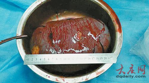 23岁小伙腹中现巨型脾 重达7斤如篮球大小