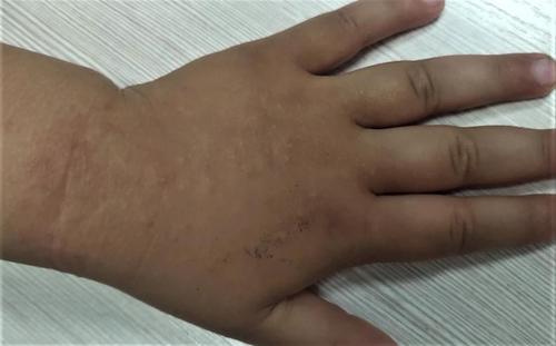 夏日常见儿童皮肤病沙土皮炎