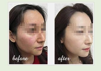 青春痘要怎么治疗好得快 - 重庆华肤医院治疗痘痘_样