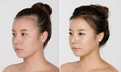 【冰点脱毛】opt冰点e光脱毛 发际线199元包脱