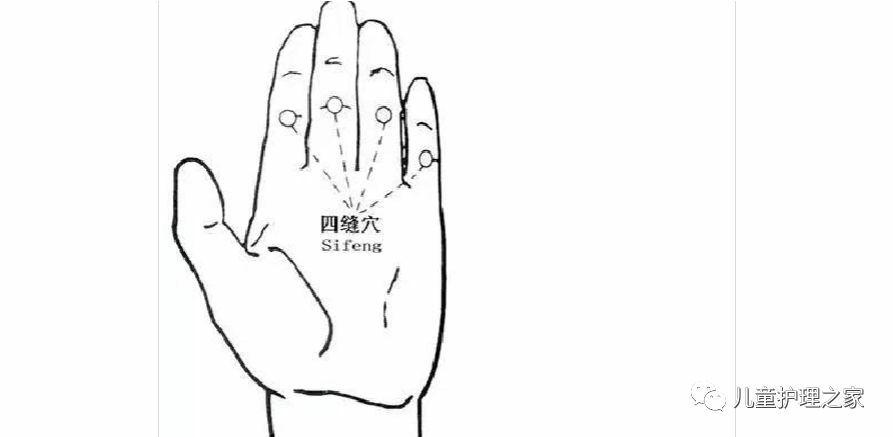 写美篇 四缝穴,属经外奇穴,民间一些老太太所谓"扎食气",即是此种疗法