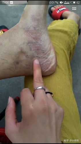 今年23岁,各位可以帮我看看[在大腿]这是毛细血管扩张