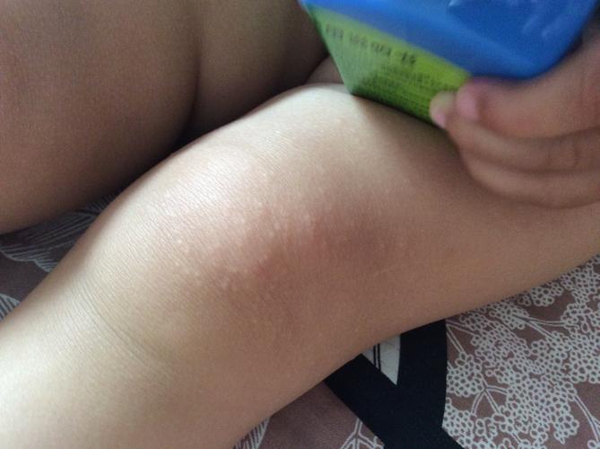 你好我家宝宝16个月昨天中午睡觉醒了发现大腿上和膝盖上起了一