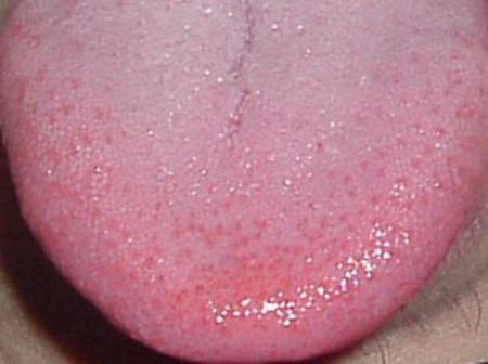 艾滋病舌头图片