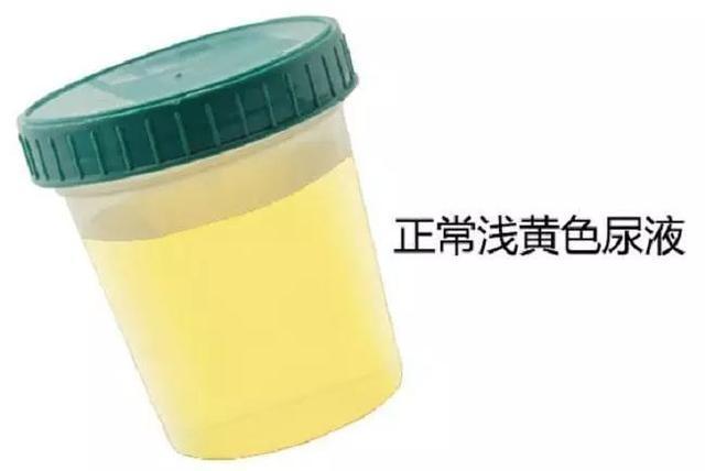 泡沫尿就一定代表有肾脏病吗?医生