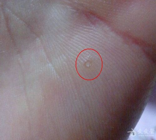 我问了度娘,资料如下:百科名片----剥脱性角质松解症本病是一种掌跖部