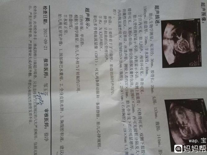 胎儿全身水肿第一次听说