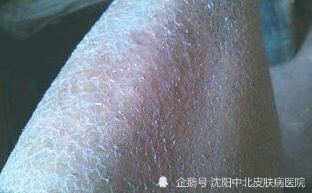 银屑病和鱼鳞病的症状图片有哪些|皮损|皮肤病|鳞屑