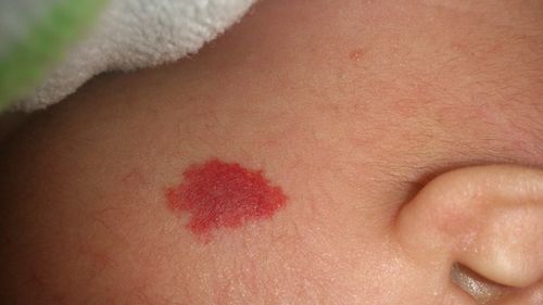 求大夫~新生儿脸颊红斑,是血管瘤么?