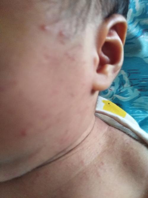 我的宝宝出生十三天了,可是身上的热毒没散去,怎么办?