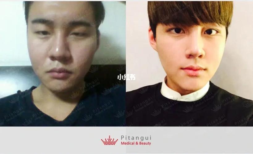 男士全面部整形前后对比效果分享_整容_医美_设计_你尝试过医美吗?