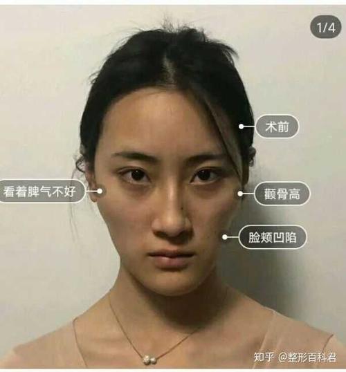 颧骨内推手术和填充只 能同时做一个手术,千万两个一起做