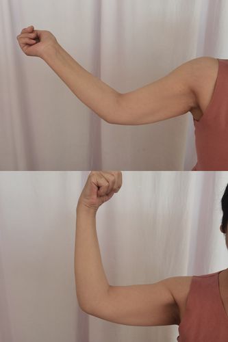 患者术前肘关节伸展明显受限,屈曲最大角度为90