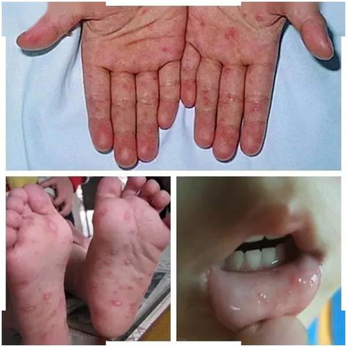 什么是手足口病?