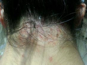 脂溢性皮炎图片