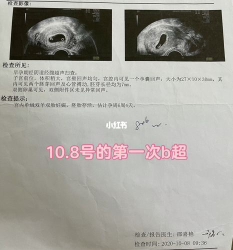 同卵双胞胎变三胞胎_双胞胎_b超_怀孕_胎停_建档_三胞胎_母婴_孕产