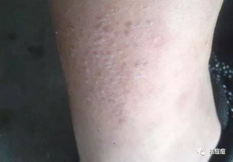 主要是四肢,尤其是下肢,特别是小腿,我们也称为冬季性皮炎
