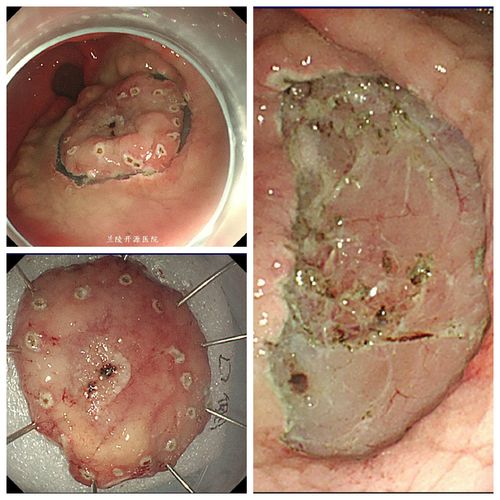 写美篇 病例1(食管早癌): 病例2(贲门早癌): 病例3(胃窦早癌): 病例4