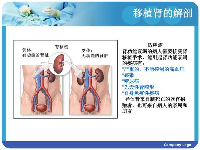 医药卫生 临床医学 肾移植术后护理查房ppt  手术指征 移植肾的解剖