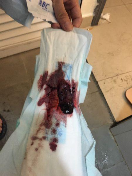 怀孕46天 宫内看不到孕囊 然后开始出血 出血第三天流出组织物