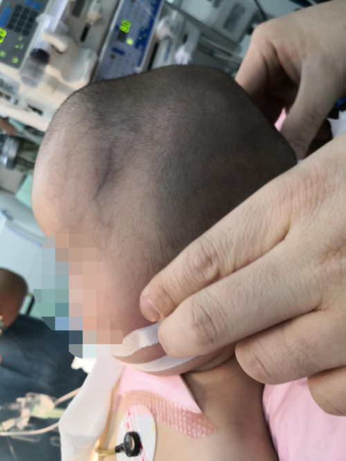 那么,狭颅症(颅缝早闭)究竟是怎么一回事呢?