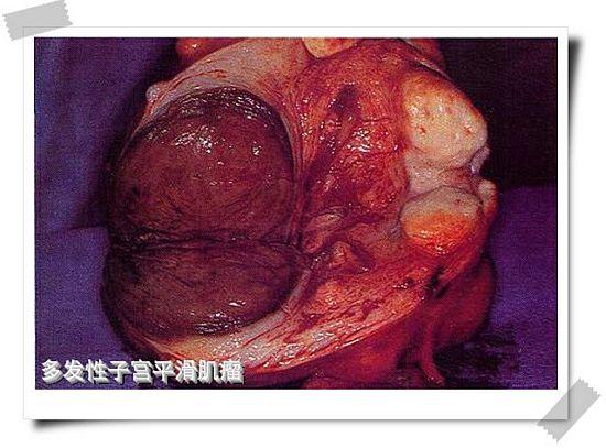 左侧较大的平滑肌瘤显示有出血(红色变性).