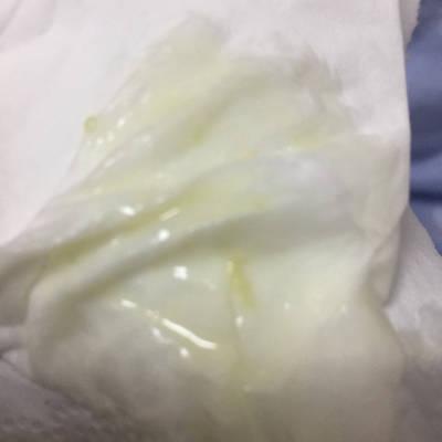 同房后就出现黄色物体怎么回事.