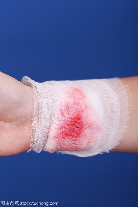 手受伤绷带包扎