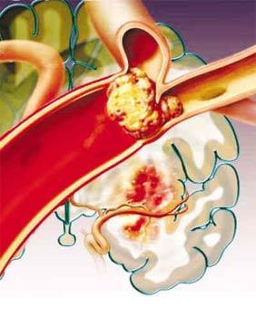 白色血栓的定义