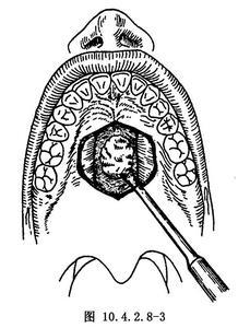 共收录 7197 个手术  腭部良性肿瘤切除术用于腭部良性肿瘤的治疗