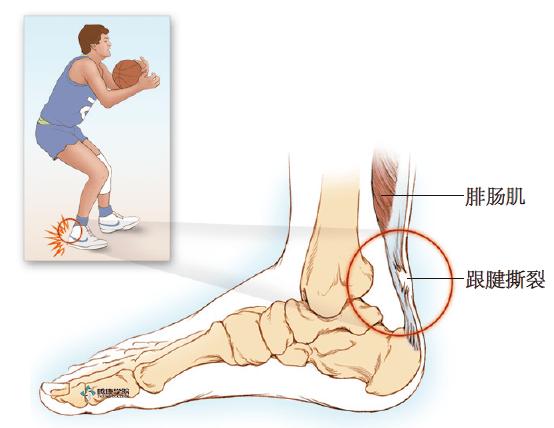 疼痛解剖学|跟腱炎