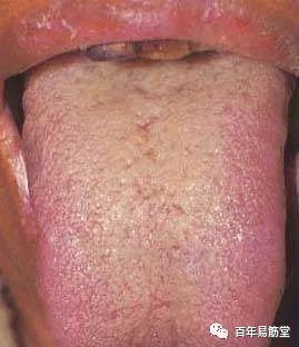 舌诊图谱,图文对照,珍藏版!_舌苔