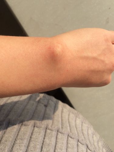 手腕处包挺鼓的,正常么