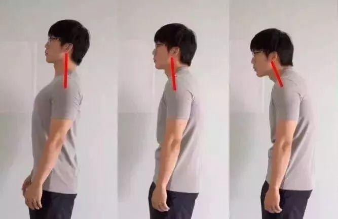 成年后大部分人驼背都是因为姿势习惯不对,肌肉无力,就算没有明显