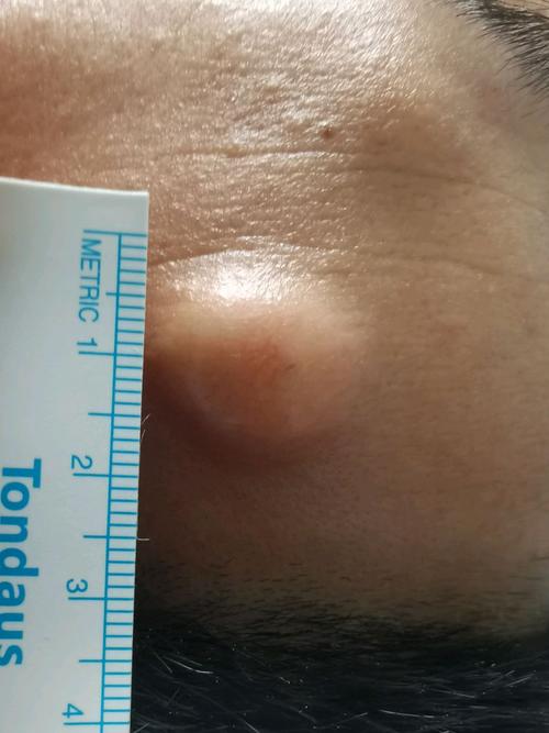 皮脂腺囊肿粉瘤微创手术