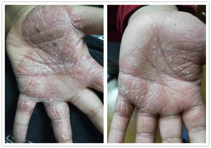 慢性湿疹结节性痒疹特应性皮炎中医中药治疗案例