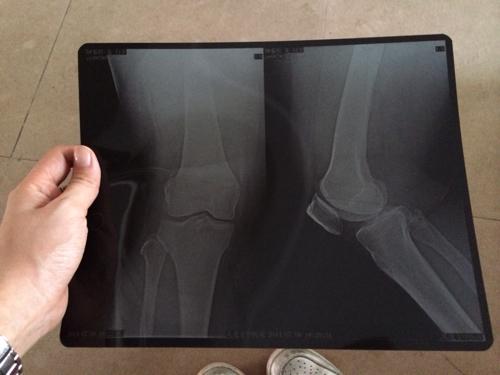 妈妈膝盖一直吵着说痛,今天去照x光,医生说是骨质增生,想问问各位专家