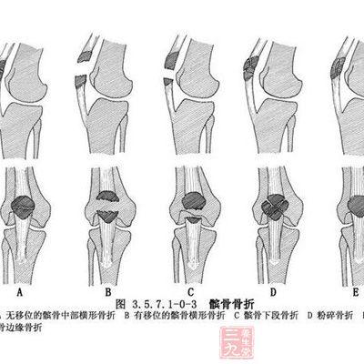 髌骨骨折的原因 为什么会患上髌骨骨折