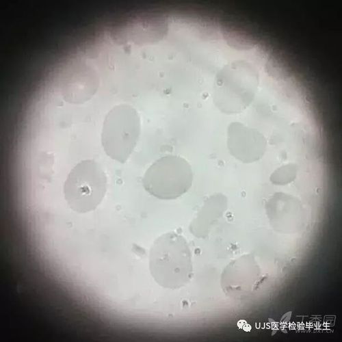 由三个案例,浅谈血小板直方图的意义