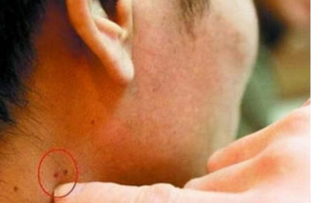 艾滋病在出现之前皮肤会有哪些症状呢建议了解可别忽视