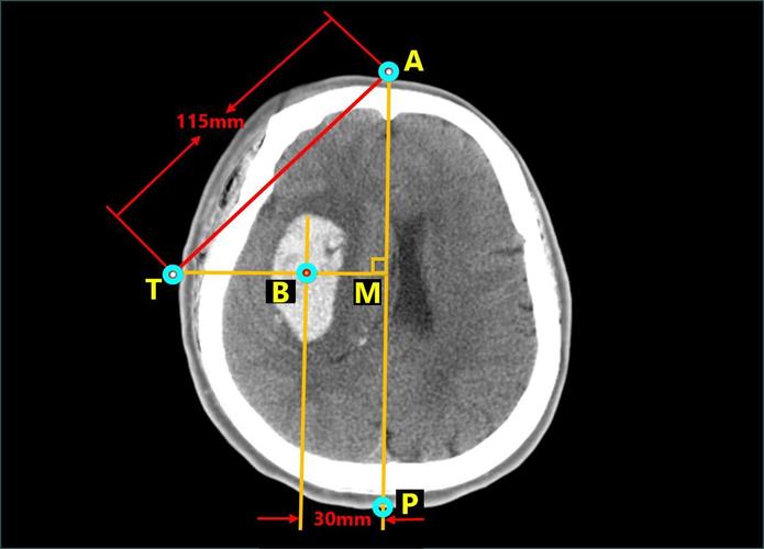 =115mm(弦长),t(temporal)就是血肿中心点b(blood)在颞部的体表投影点
