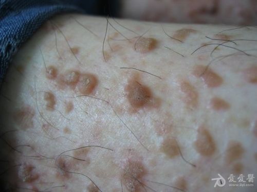 楼主苦丁茶1682013-04-12 10:15:13   疣状肢端角化病(acrokeratosis