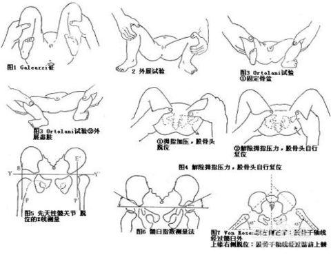 小儿髋关节脱位怎么办?