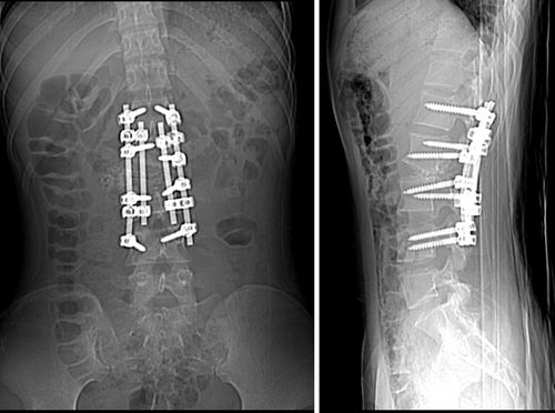 先天性脊柱侧弯畸形 l3椎体半椎体畸形 腰椎侧后突畸形